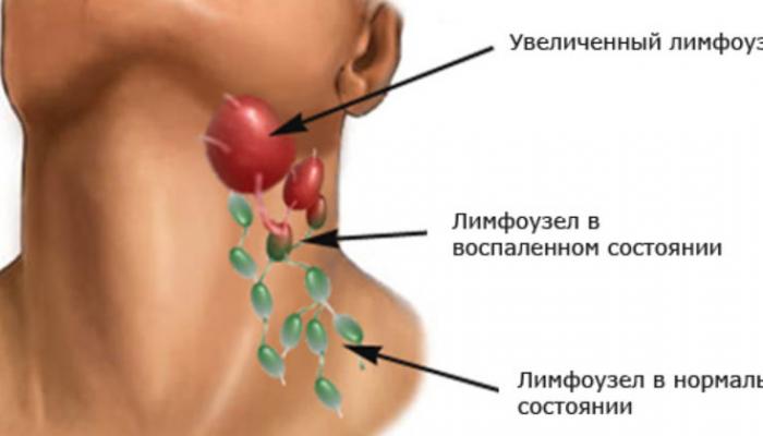 О каких болезнях предупреждают лимфатические узлы - Российская газета